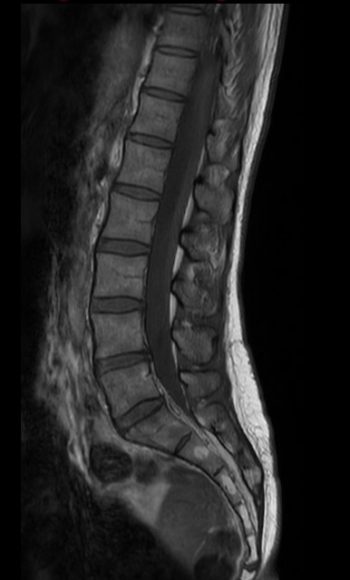 Lower spine | Radiology Template Reports